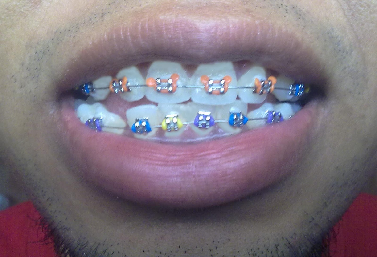 Mr Braces 7Eleven: Appt Tukar Getah Braces - Blue, Purple 