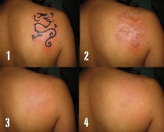 tattoos are permanent as they should be methods for removing tattoos ...