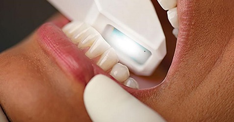 Intraoral Scanning and Inspection System