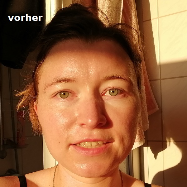 Haut vorher