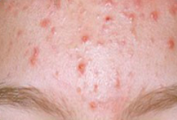 acne treatment