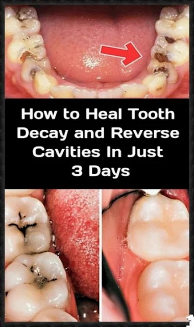 The Only 6 Natural Remedies You Need To Heal Tooth Decay and Cavities