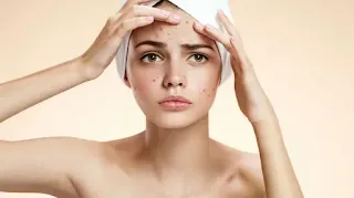 acne-mujer-adulta