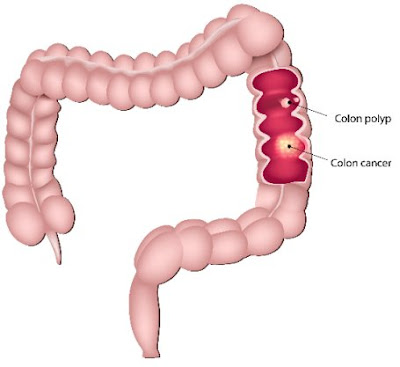 Cologuard Vs Colonoscopy effectiveness.