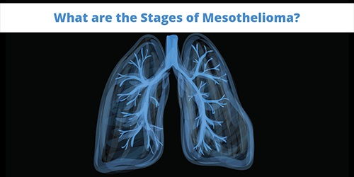 Stage 4 Sarcomatoid Mesothelioma