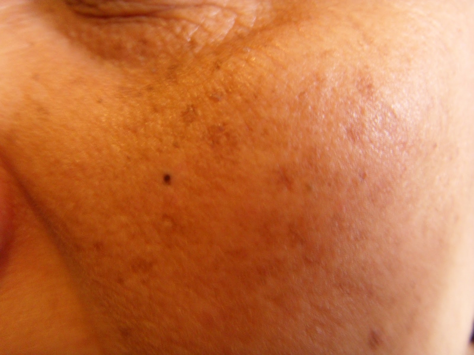 Dry Skin / Pigmentation / Open Pores