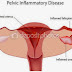 Mari memahami seputar Penyakit Radang Panggul