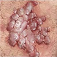 Obat Kutil Kelamin Malaysia Obat Kutil Kelamin Malaysia