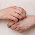 Monkeypox ( symptoms, couses & treatment )
