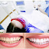 Tẩy trắng răng có hại gì không? 