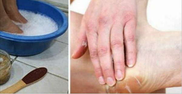 Get Rid Of Dry And Cracked Feet