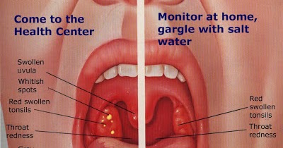 Apa itu Tonsil??? Bahaya nya tonsil. ~ Vitamin Sihat 