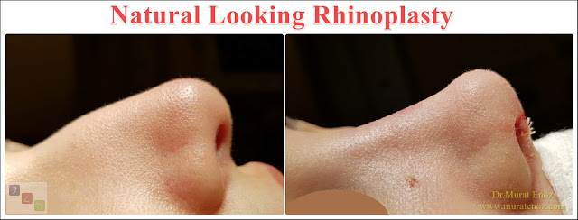 Natural Looking Rhinoplasty - Natural Nose Job - Natural Rhinoplasty - Female Nose Aesthetic Surgery - Nose Jobs For Women - Nose Reshaping for Women - Best Rhinoplasty For Women Istanbul - Female Rhinoplasty Istanbul - Nose Job Surgery for Women - Women's Rhinoplasty - Nose Aesthetic Surgery For Women - Female Rhinoplasty Surgery in Istanbul - Female Rhinoplasty Surgery in Turkey