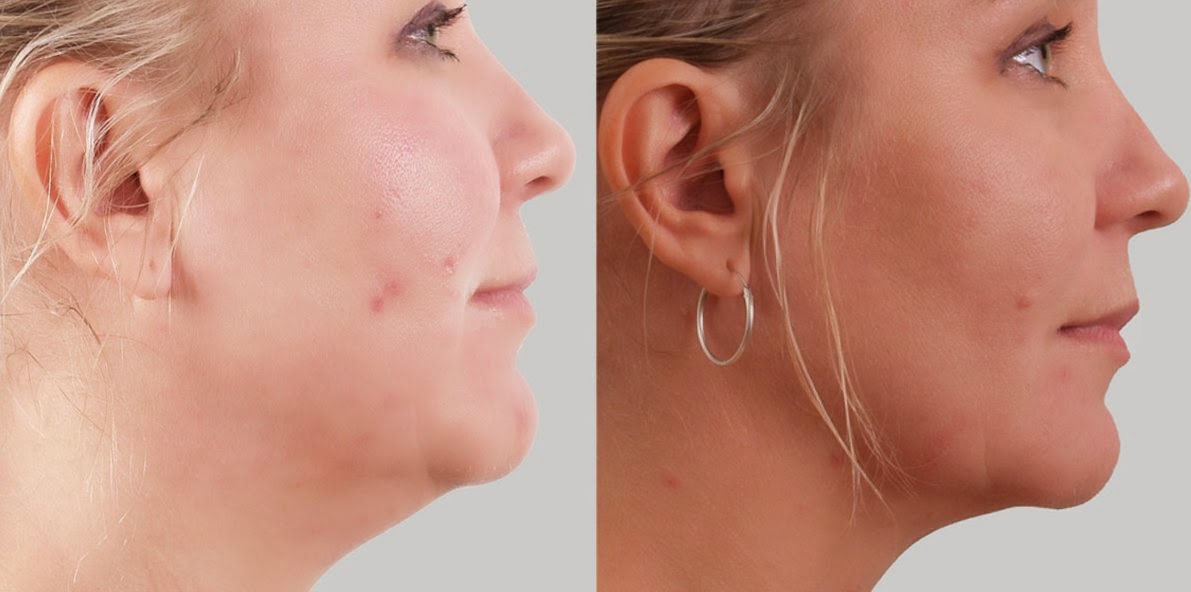 How To Firm Up And Improve Sagging Face Skin Without Surgery