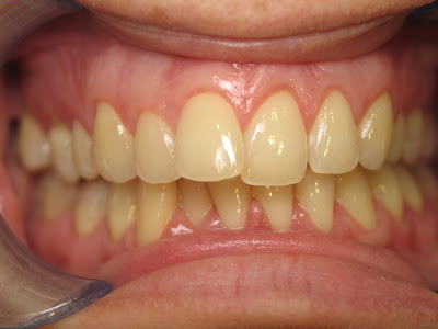  Nguyên nhân gây nhiễm màu răng