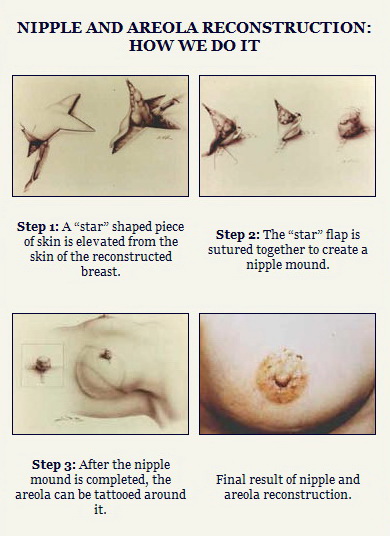 Tegs: the whitney center for permanent cosmetics areola nipple after. The areolar circle can be made using either a medical tattoo or a skin graft