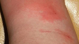 Cellulitis Pharmacotherapy