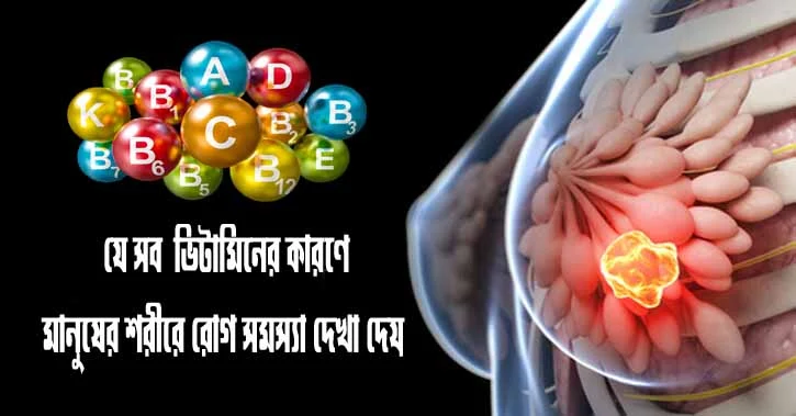 যে সব  ভিটামিনের কারণে মানুষের শরীরে রোগ সমস্যা দেখা দেয়