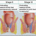 Obat Wasier Hemmorhoida