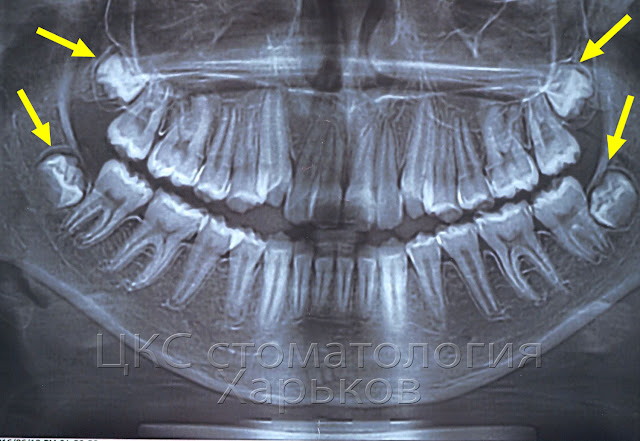 панорама до ортодонтического лечения