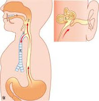 Il est une condition très courante appelée globus pharyngis qui est le mieux décrit comme se sentir comme il ya une boule dans la gorge . Bien que cette condition peut être causée par de nombreux facteurs différents , le reflux acide est une des principales causes de globus pharyngis