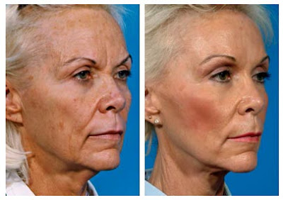 Temporal Brow Lift