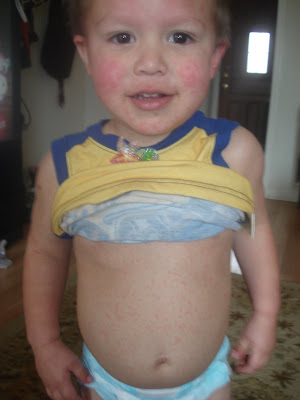 chicken pox baby. THE CHICKENPOX!