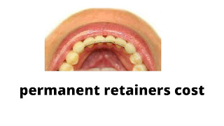 Permanent Retainer Cost After Braces
