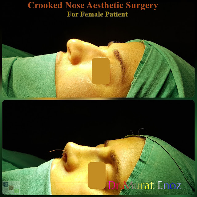 Crooked Nose Aesthetic Surgery For Women