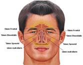 sinusitis