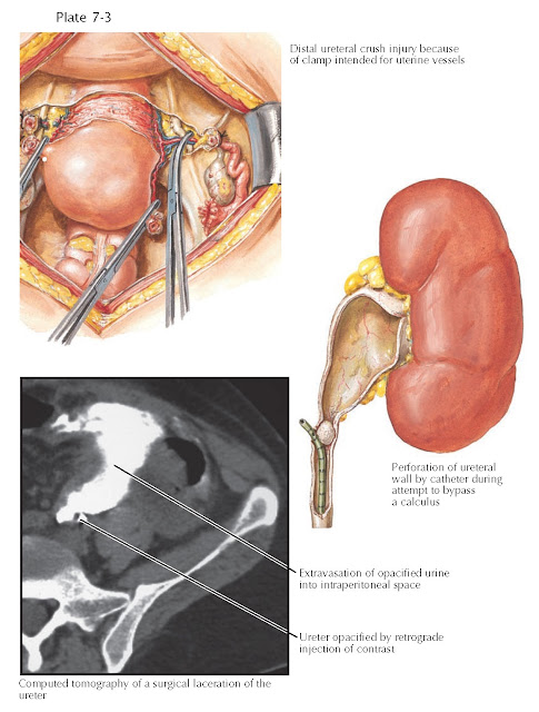 URETERAL INJURIES