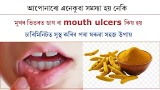 Mouth Ulcers