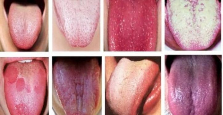 Here's What The Color Of Your Tongue Reveals About Health