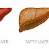 The Complete Guide to Fatty Liver Disease and How it Affects Your Health