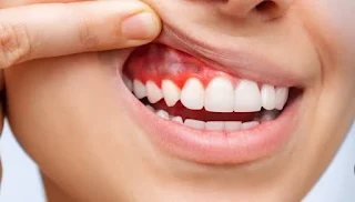 Gum Disease: Causes, Signs & Best Treatments