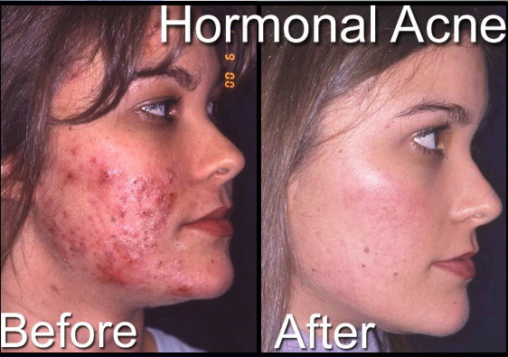 Cystic acne treatments do not have to be terrible or intimidating