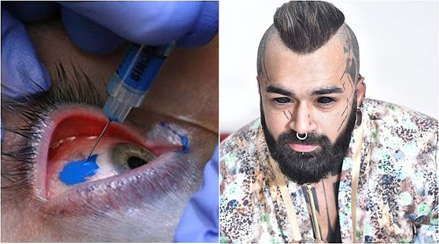 Karan King,Delhi Man Is The 1st Indian To Get An Eyeball Tattoo 