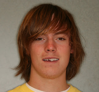 Boulder porcelain veneers patient after his accident.