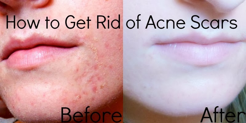 How to Get Rid of Acne Scars