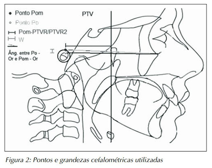 PDF: Estimativa da variação topográfica na determinação do ponto pório