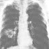 Hati-hati terhadap penyakit flek paru-paru