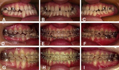 Sự thay đổi của răng trong quá trình niềng răng