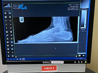 Photo of a screen showing an x-ray of my right foot.