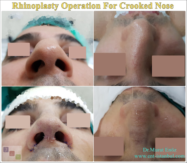 Rhinoplasty Operation For Crooked Nose