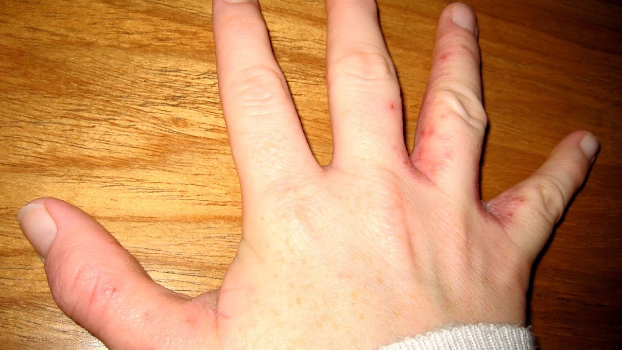White Itchy Bumps On Hands