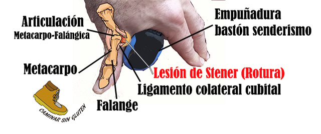 Lesión de stener, pulgar del esquiador o senderista