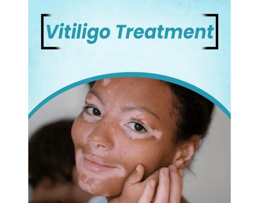 early stages of vitiligo