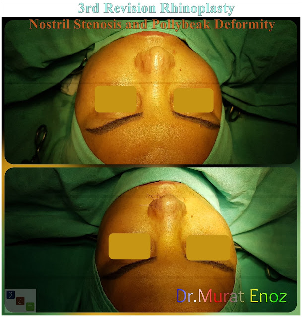 3rd Revision Rhinoplasty - Nostril Stenosis and Pollybeak Deformity - Complication Nose Surgery