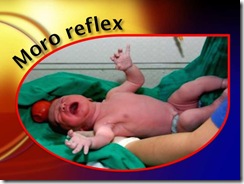 moro reflex medicalshow