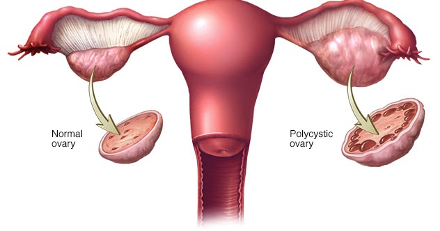 TIPS MENGATASI MASALAH PCOS AGAR CEPAT HAMIL